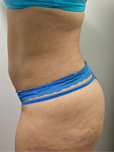 DrenoLipo - Antes