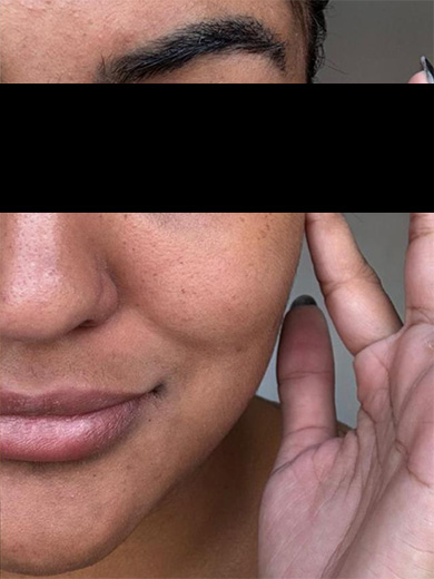 Laser Lavieen rosto - Depois